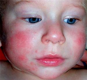 allergija-u-grudnichkov-kak-projavljaetsja-i-kak-1.jpg