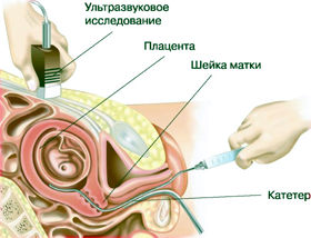 Амниоскопия при беременности.