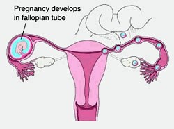 Что такое внематочная беременность и ее признаки.