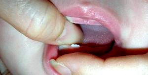 Прорезывание зубов у детей. Симптомы при прорезывании зубов у детей